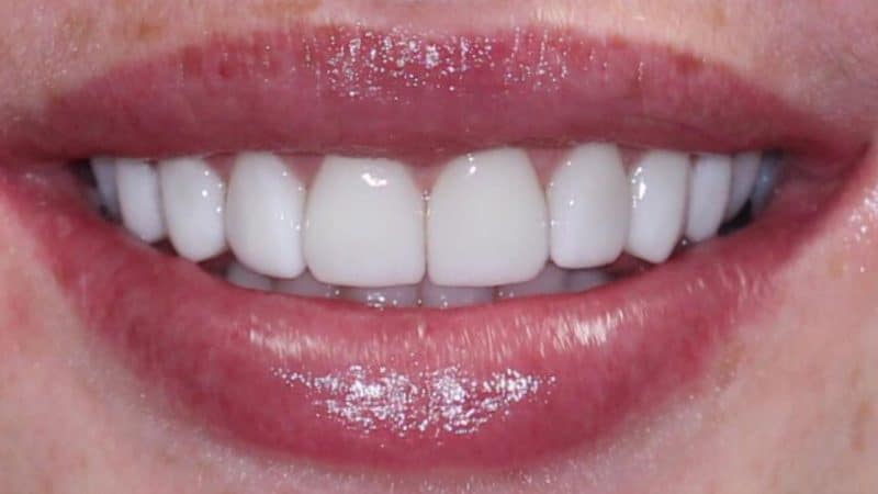 After dental treatment – case 3