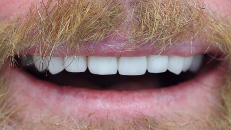 After dental treatment – case 4