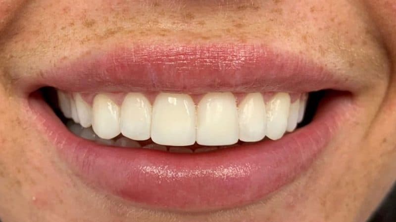 After dental treatment – case 5