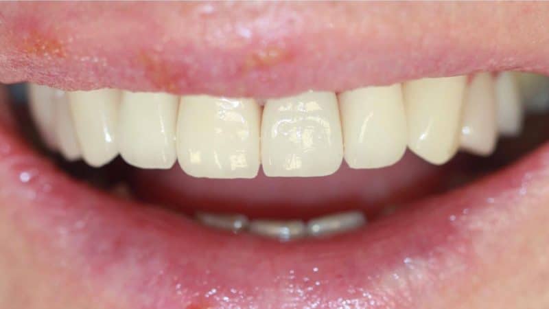 After dental treatment – case 1