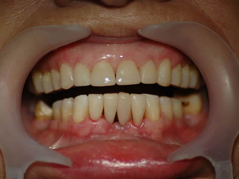 After dental treatment – case 6