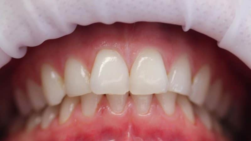 Before dental treatment – case 3