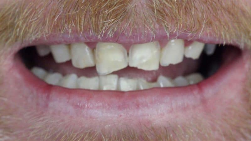 Before dental treatment – case 4