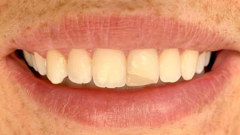 Before dental treatment – case 5
