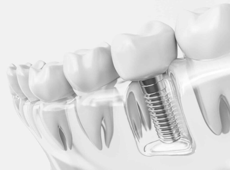 Ashbourne Dental & Medical – implant1
